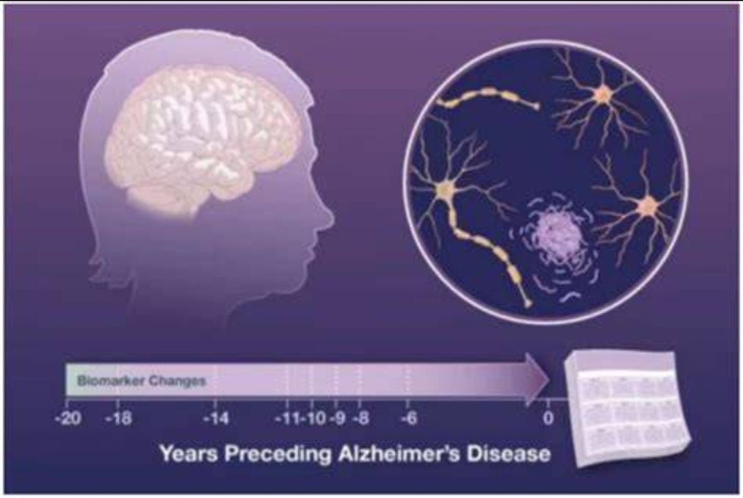 Pharmacological Treatment of Alzheimer's Disease - ZenWave Precision 40Hz
