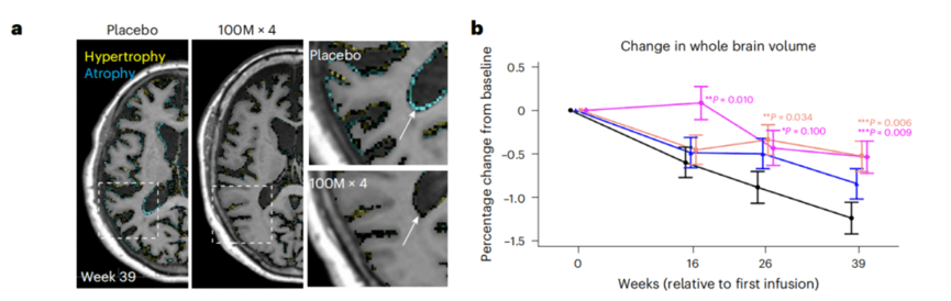 Phase II Study: Mesenchymal Stem Cell Therapy for Mild Alzheimer’s Shows Anti Inflammatory Effects and Slows Brain Atrophy - ZenWave Precision 40Hz