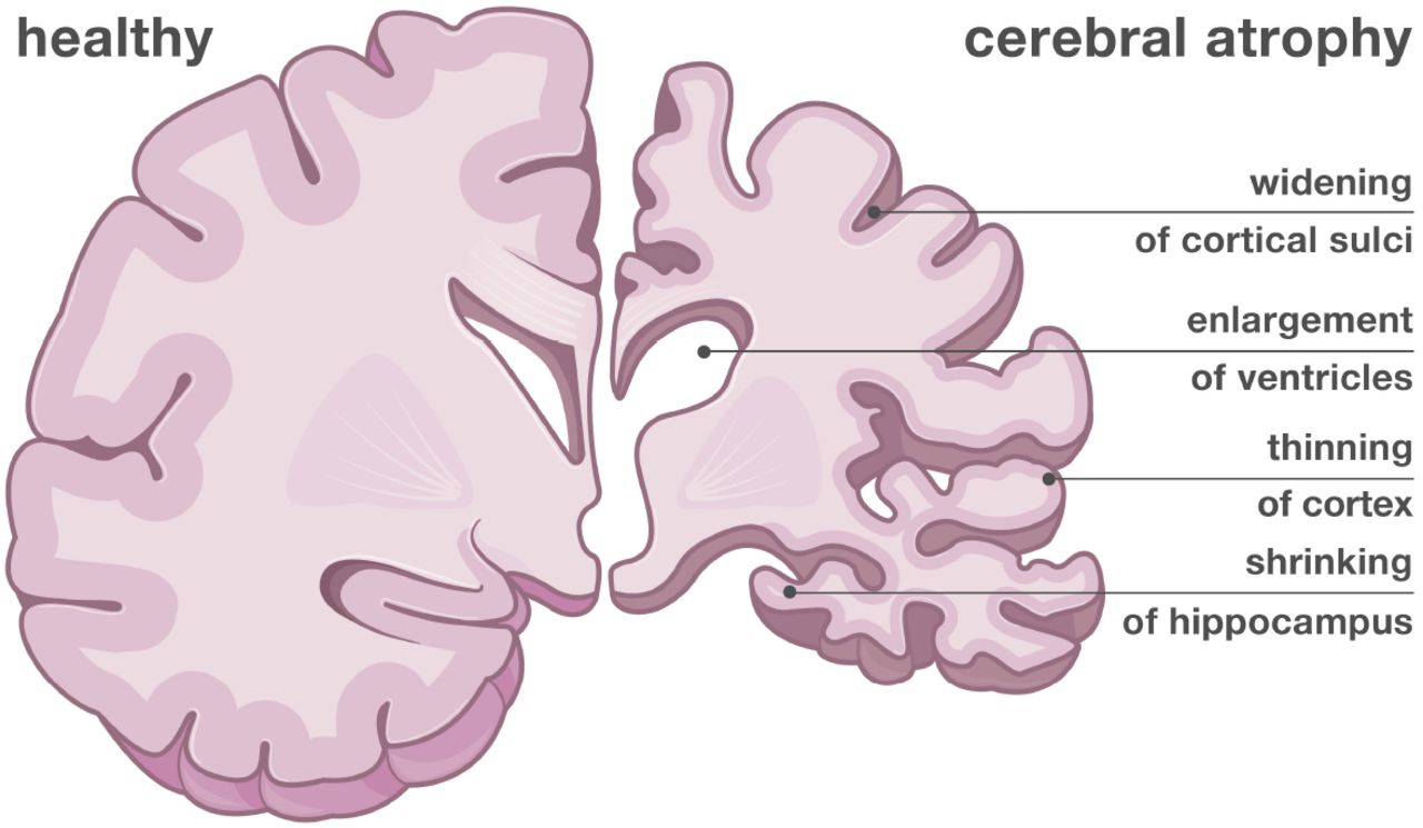 sizes and shapes differ between a normal brain and an Alzheimer's brain