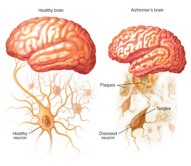 the differences in brain cell health and numbers between the two