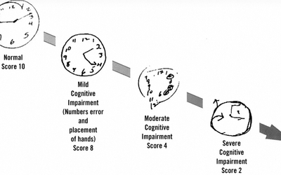 Can Drawing a Clock Really Detect Alzheimer's? — A Guide to Simple Screening Tools