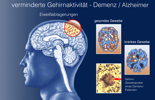 Understanding the Truth About Alzheimer’s Disease and How to Prevent It - ZenWave Precision 40Hz