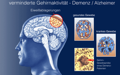 Understanding the Truth About Alzheimer’s Disease and How to Prevent It